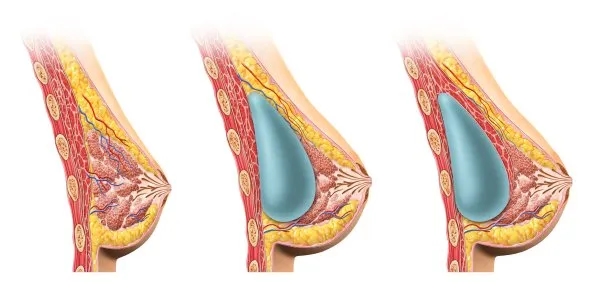 Implanty 325 ml jaki to rozmiar i jak wpłyną na Twój wygląd